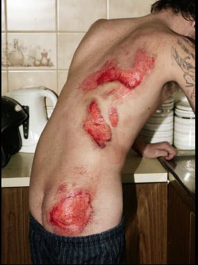 Motorbike rider showing injuries.jpg
